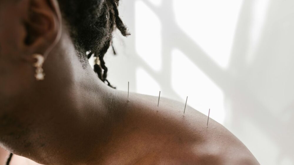 Acupuncture needles inserted into a person's shoulder and upper back.